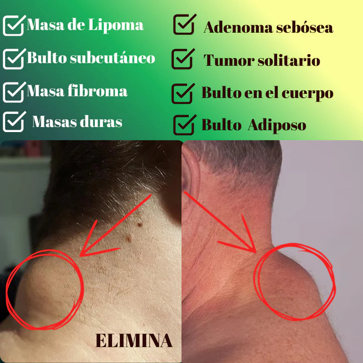 LIPOMAX® – ¡Spray Efectivo Para Reducir Bultos Adiposos!
